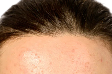 Oily skin image with acne scars, illustrating skin imperfections