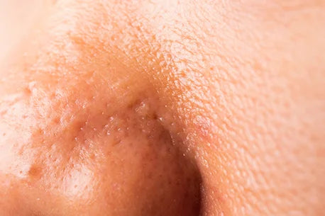Photo of woman with large pores and freckles on her oily cheeks