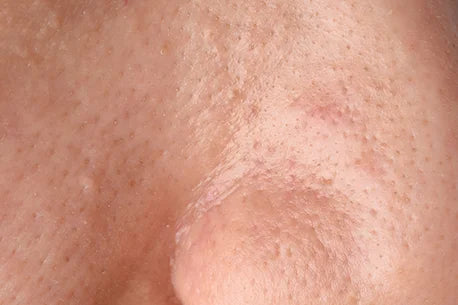 image of greasy oily face with comedones, depicting a skin problem