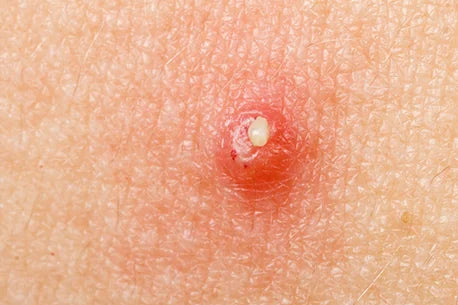 Photo of pustulous cystic acne on skin