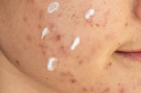 image of woman with half her face showing acne inflammation