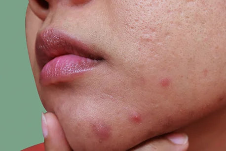 Pustules and whitehead acne picture on the face