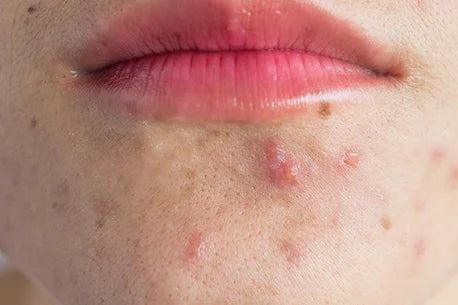 close-up of half of a woman's face with acne inflammation image