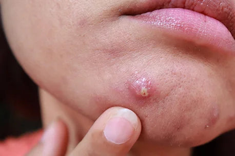 woman removing pustules and whitehead acne image from her face