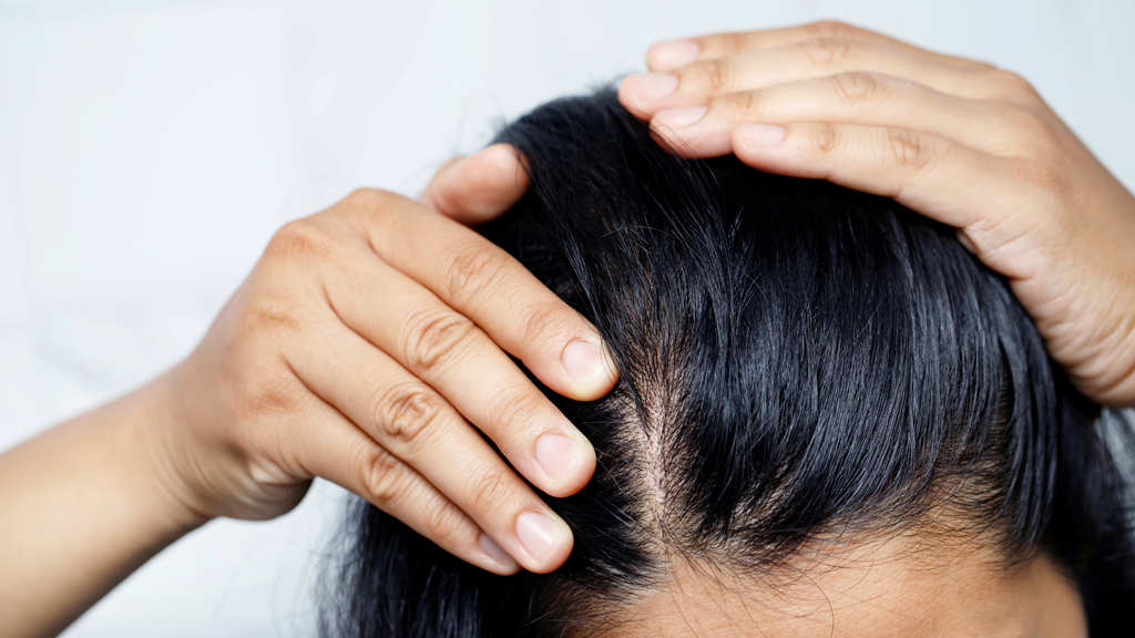 Female Pattern Baldness | Herbal Hair Blog