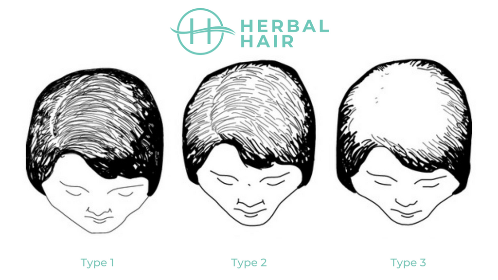 Types of Female Pattern Baldness | Herbal Hair Blog