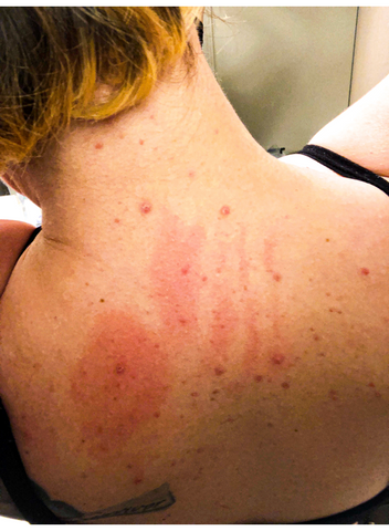 morgellons disease skin rash