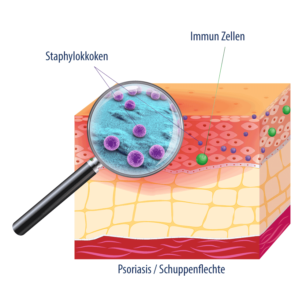 Hautquerschnitt_Psoriasis.gif__PID:2410c635-9186-4aa2-96cd-568b2a0463dd