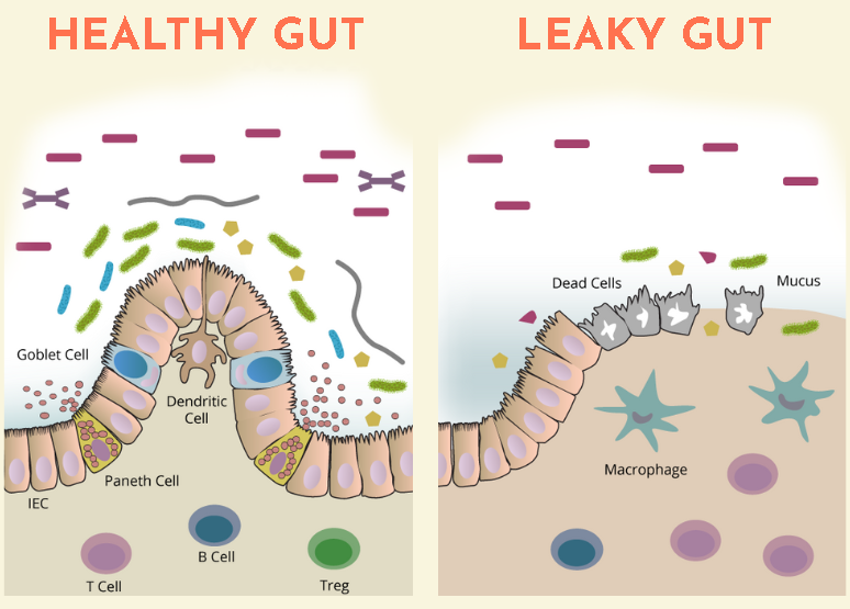 leaky gut microbiome vs healthy gut microbiome 