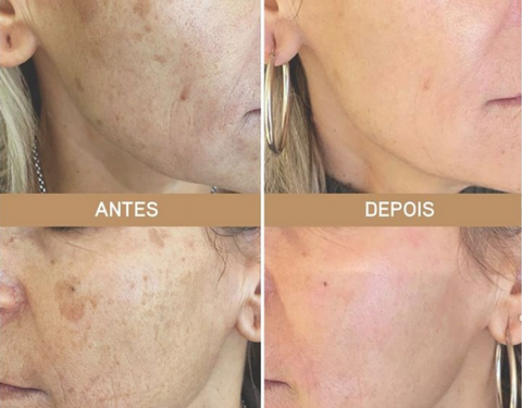 Quatro colagens de mulheres que utilizaram o Creme YOUNGCÖME Original, mostrando o antes e o depois do uso, com resultados significantes em sua pele.