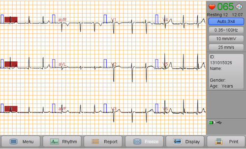 Simultaneous 12-lead acquisition