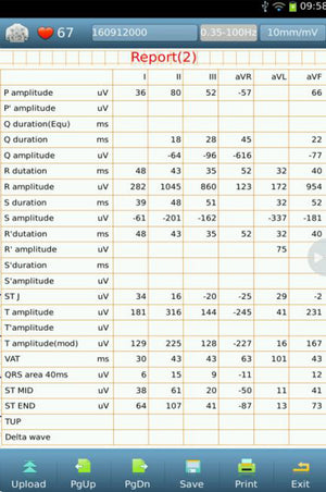 standard 12-lead ecg report II