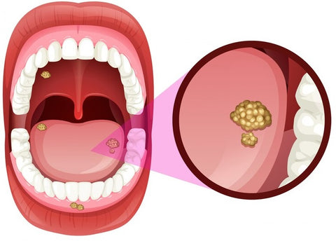 Halitosis