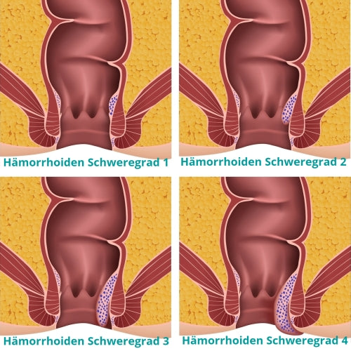 Schweregrade von Hämorrhoiden