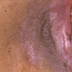 Lichen sclerosus an der Vulva