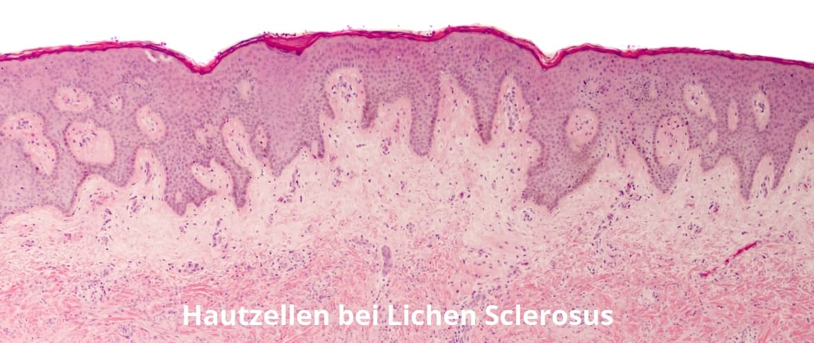 Krankheitsbild - Dilator bei Lichen sclerosus