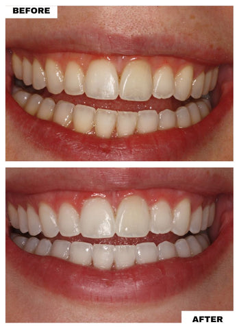 Leave-in Teeth Whitening Strips