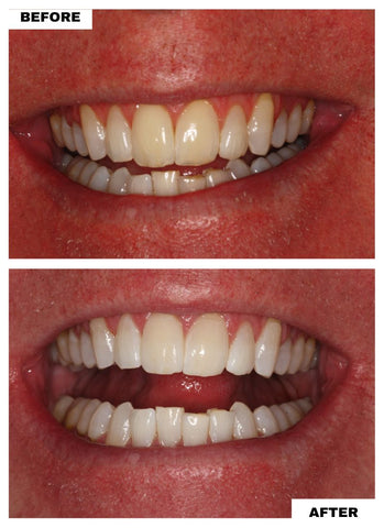 Discoloration and Mottling of Teeth