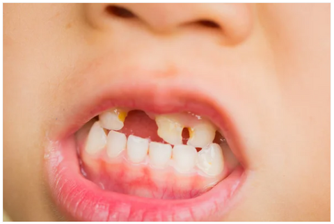 Possible damage to tooth enamel