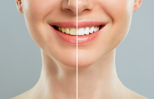 Whitening Your Teeth is Now More Affordable than You Think