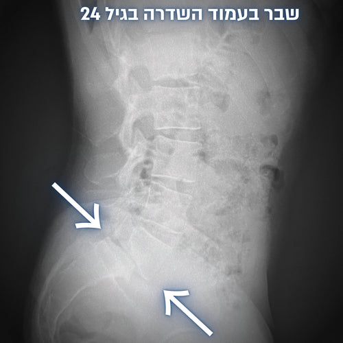 צילום רנטגן של שבר בעמוד השדרה הגורם לכאבי גב תחתון גב תחתון תפוס וכאבי גב