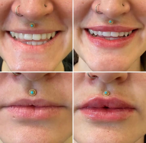 Lip Filler Gilbert, AZ before & after