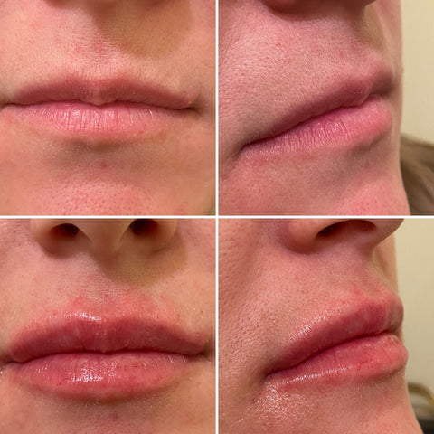 Lip Filler before & after