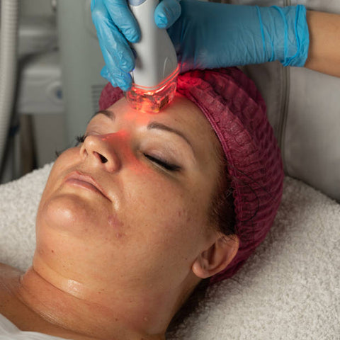 Benefits of Red Light Therapy on Acne