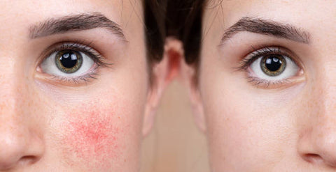 Rosacea and light therapy