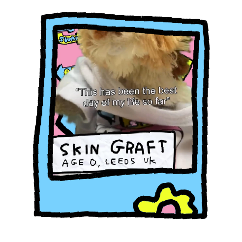 Skin Graft Arm Swap