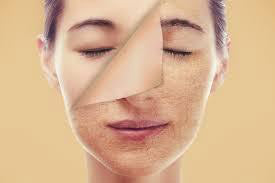 lady face skin restoration peeling