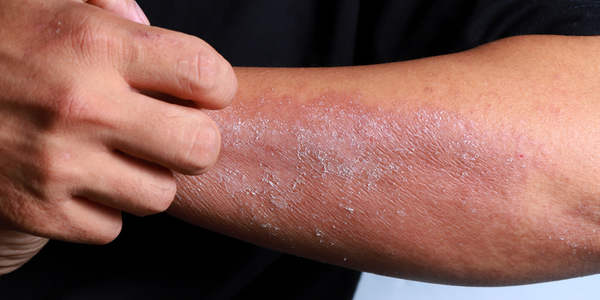 Personne atteinte de dermatillomanie en train de se gratter le bras