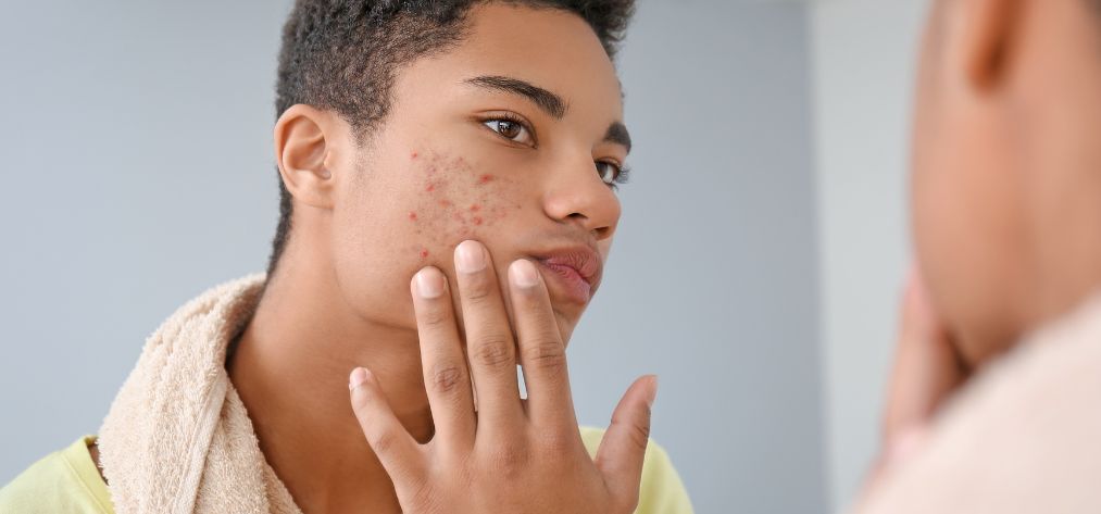 different types laser acne scars