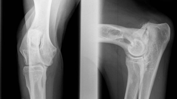Radiograph showing ununited anconeal process (UAP), fragmented coronoid process (FCP) and osteoarthritic changes.