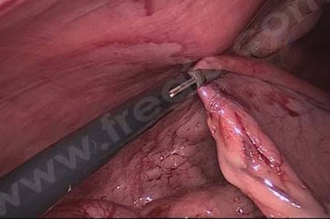 Intraoperative view of dilatation with torsion of the stomach. You can notice significant damage to the stomach and signs of necrosis due to dog bloat.