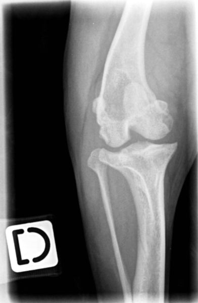 An x-ray showing a front view of a ruptured cruitiate ligament in an adult dog . The patella isn't in its normal position.