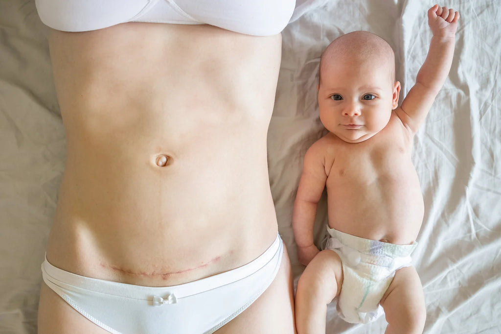 Photo of a mom's C-section scar and a baby laying next to her in bed with arm raised over their head