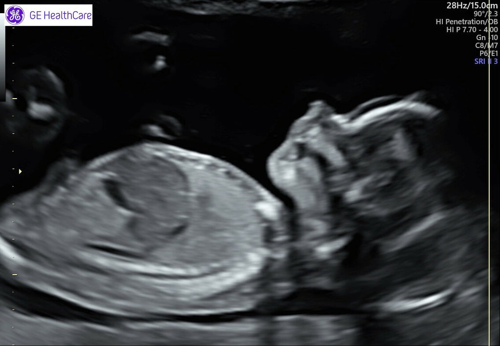 A sonogram photo of Stella.