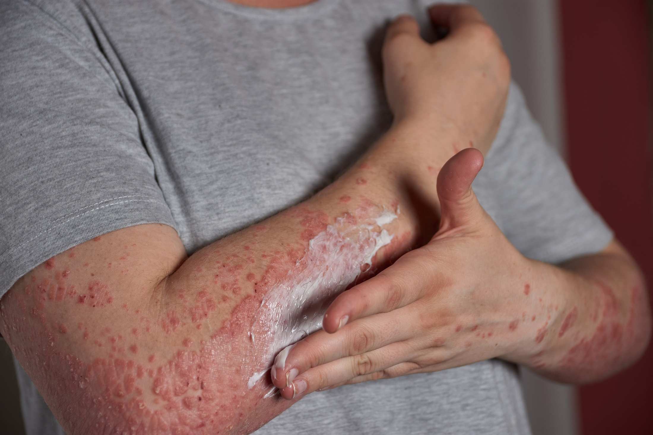 A man applying topical medication