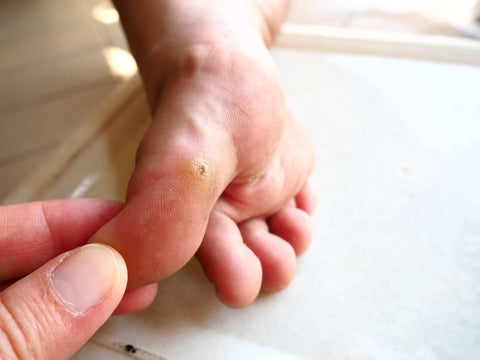 Close-up of a plantar wart.