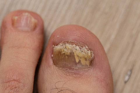 Warts in and around the nails cause damage to the nails.