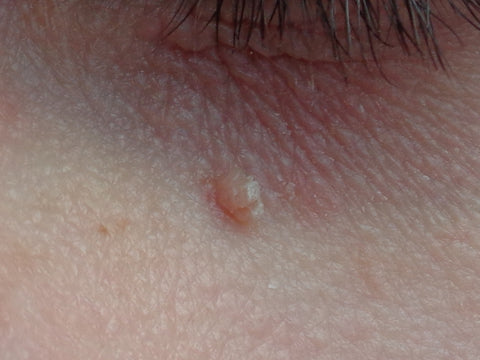 A filiform wart close to the eye.