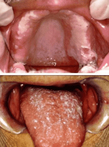 thrush at the back of the throat