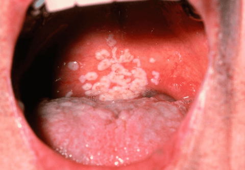 female oral thrush