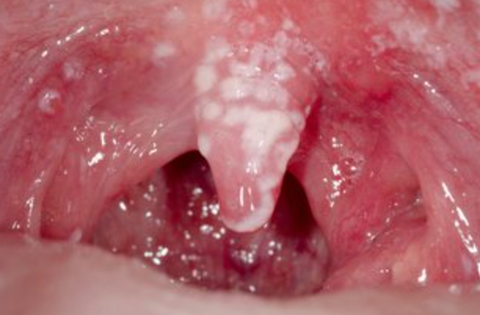tonsil thrush female