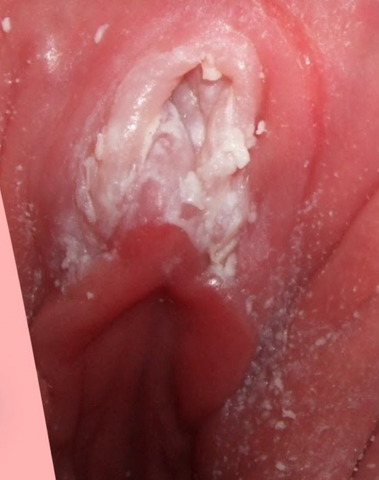 outer vaginal thrush