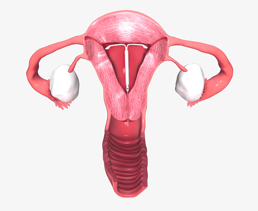 Hormonal IUD