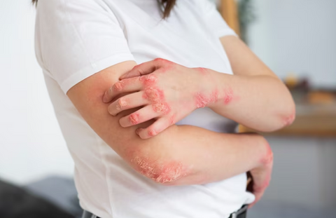 Allergic Contact Dermatitis Rash