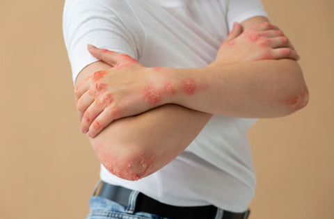 Urticaria (Hives) Rash - Raised Red Bumps on Skin