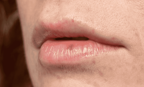 Allergic Contact Cheilitis: Redness and Swelling on Lips Due to Allergic Reaction